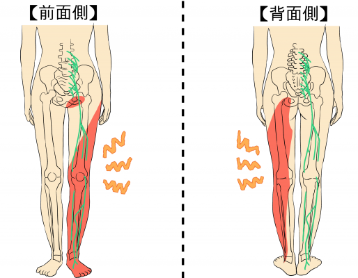 脊柱管狭窄症の病状のイラスト図