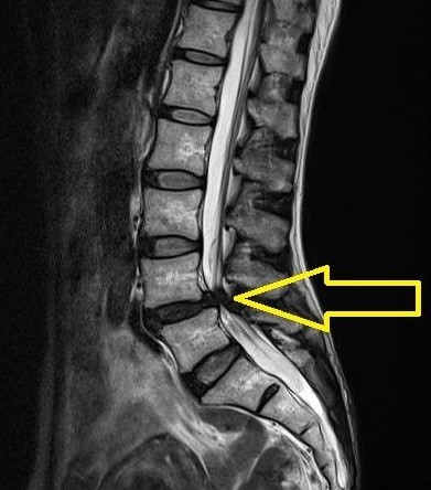 脊柱管狭窄症のＭＲＩの写真